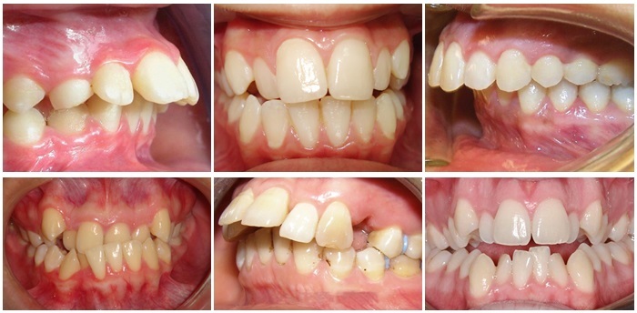 Răng khôn mọc lệch có thể gây biến chứng gì và lưu ý khi nhổ ...