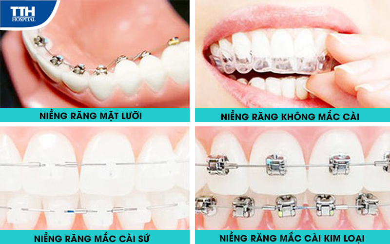 4. Các loại mắc cài và khay niềng