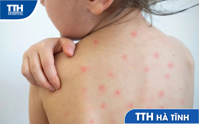 Cách Xử Lý Và Điều Trị Sốt Virus