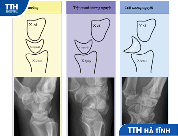 Trật Xương Cổ Tay: Triệu Chứng, Nguyên Nhân và Phương Pháp Điều Trị Hiệu Quả