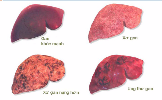 Ung thư gan - Những điều cần biết - Bệnh viện đa khoa TTH Hà Tĩnh