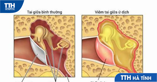 Viêm tai giữa thanh dịch ở người lớn: Nguyên nhân, triệu chứng và cách điều trị