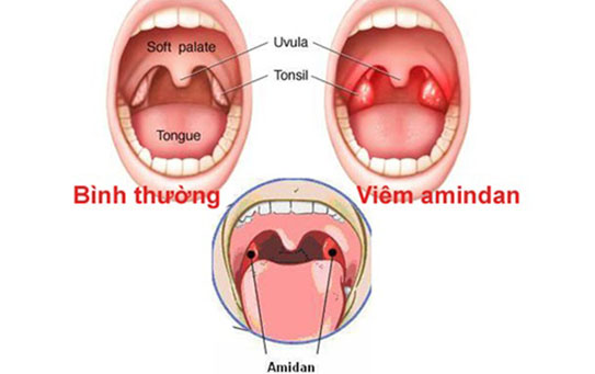 Viêm amidan cấp  và những điều cần biết