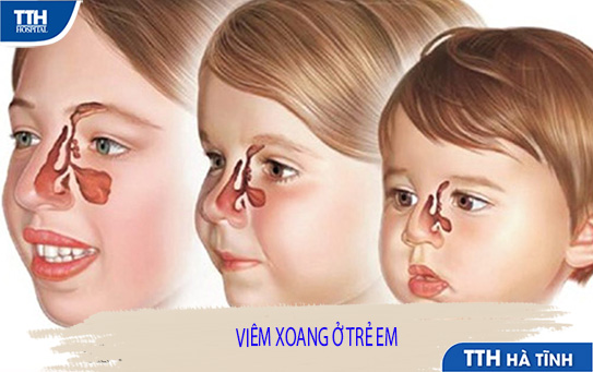 Viêm xoang ở trẻ em liệu có giống với người lớn