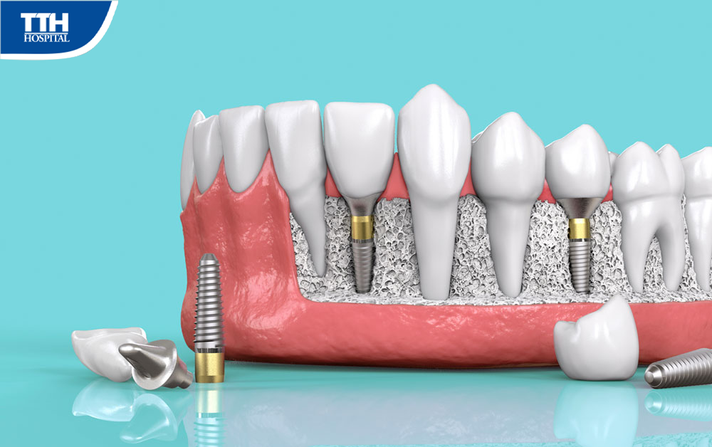 Trồng răng Implant giá rẻ có tốt không?