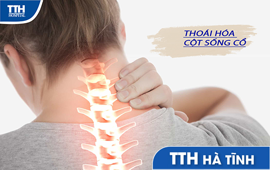 Thoái hóa đốt sống cổ và phương pháp điều trị