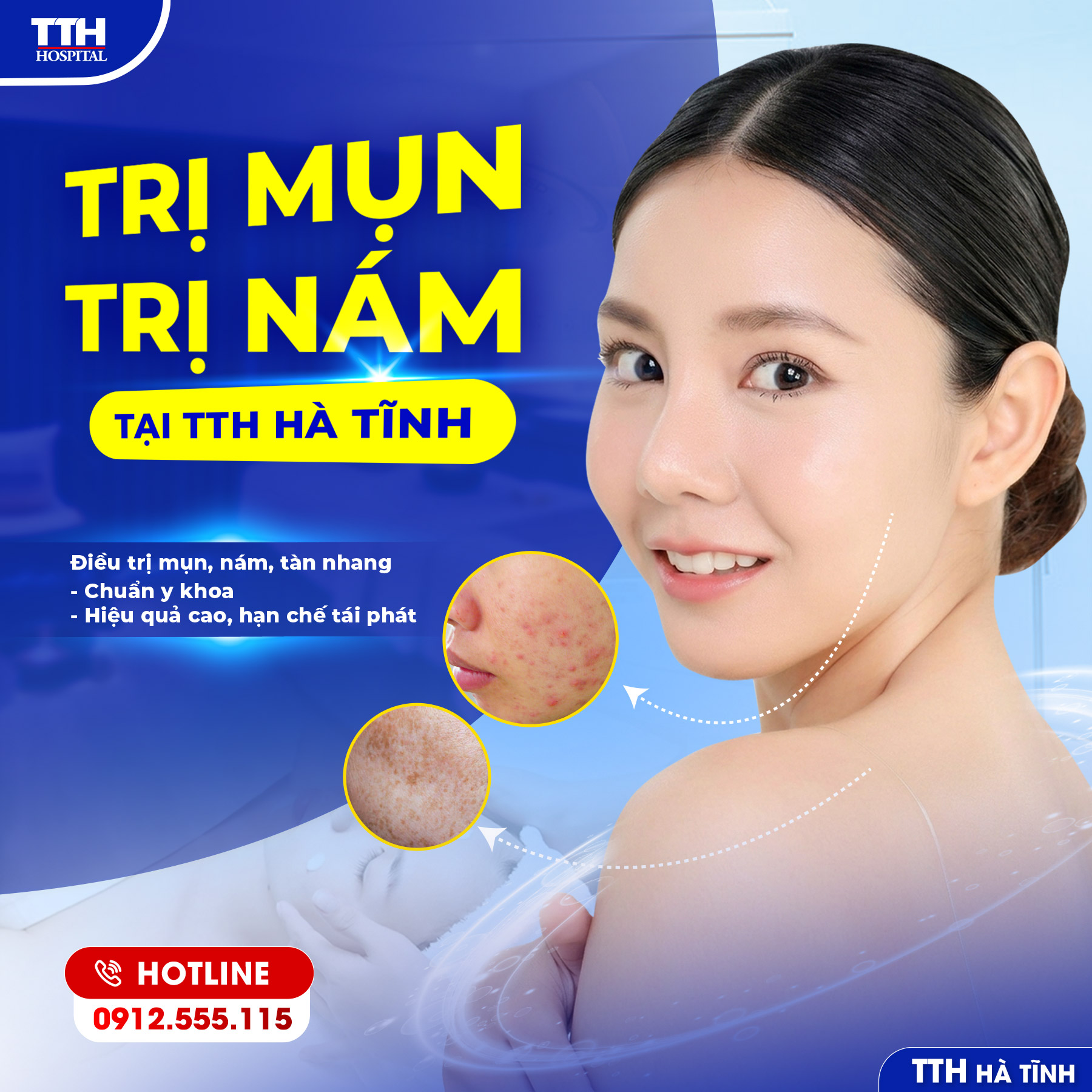 MỤN, NÁM KHIẾN BẠN MẤT TỰ TIN? ĐÃ CÓ GIẢI PHÁP CÔNG NGHỆ CAO TẠI TTH HÀ TĨNH