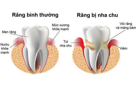 Nguyên nhân gây bệnh nha chu