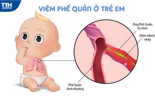 Bệnh viêm phế quản ở trẻ em