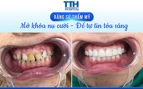 Bọc răng sứ an toàn, trắng sáng, thẩm mỹ, độ bền cao tại TTH Hà Tĩnh