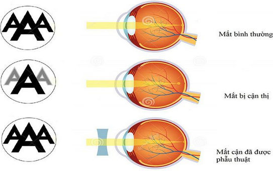 Cận thị mắt và cách phòng tránh hiệu quả