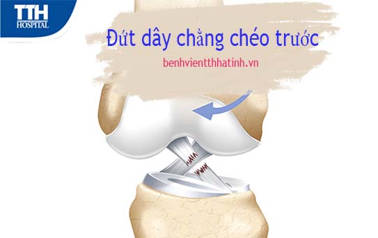 Đứt dây chằng chéo trước - Nguyên nhân và dấu hiệu