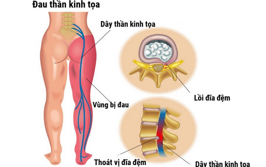 Đau thần kinh tọa - Nguyên nhân- dấu hiệu nhận biết