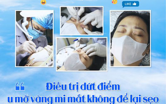 ĐIỀU TRỊ DỨT ĐIỂM U MỠ VÀNG MI MẮT KHÔNG ĐỂ LẠI SẸO BẰNG CÔNG NGHỆ LASER CO2