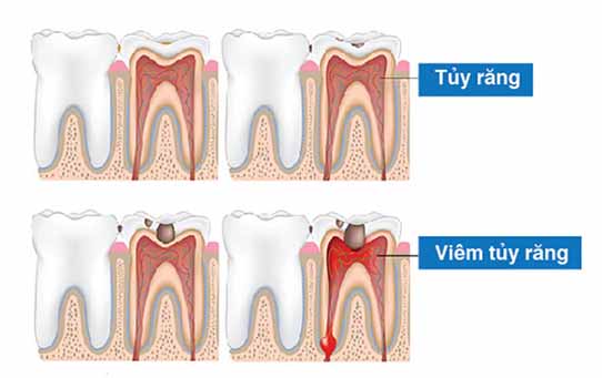 Viêm tủy răng và cách điều trị