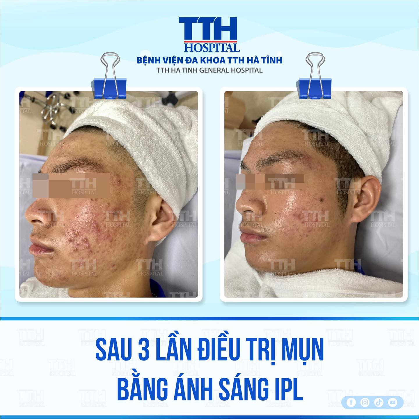 ĐIỀU TRỊ MỤN BẰNG ÁNH SÁNG IPL TẠI BVĐK TTH HÀ TĨNH - DA SẠCH MỤN, SÁNG MỊN