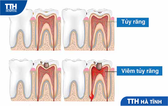 Viêm tủy răng và cách điều trị