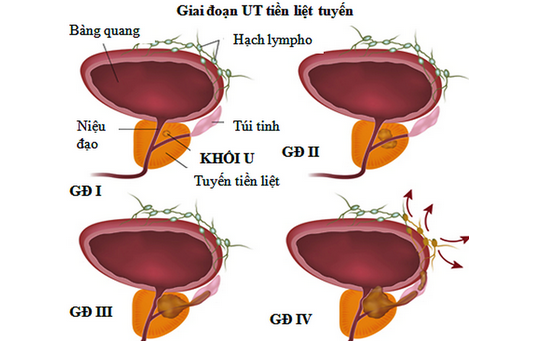 Tầm soát ung thư tuyến tiền liệt