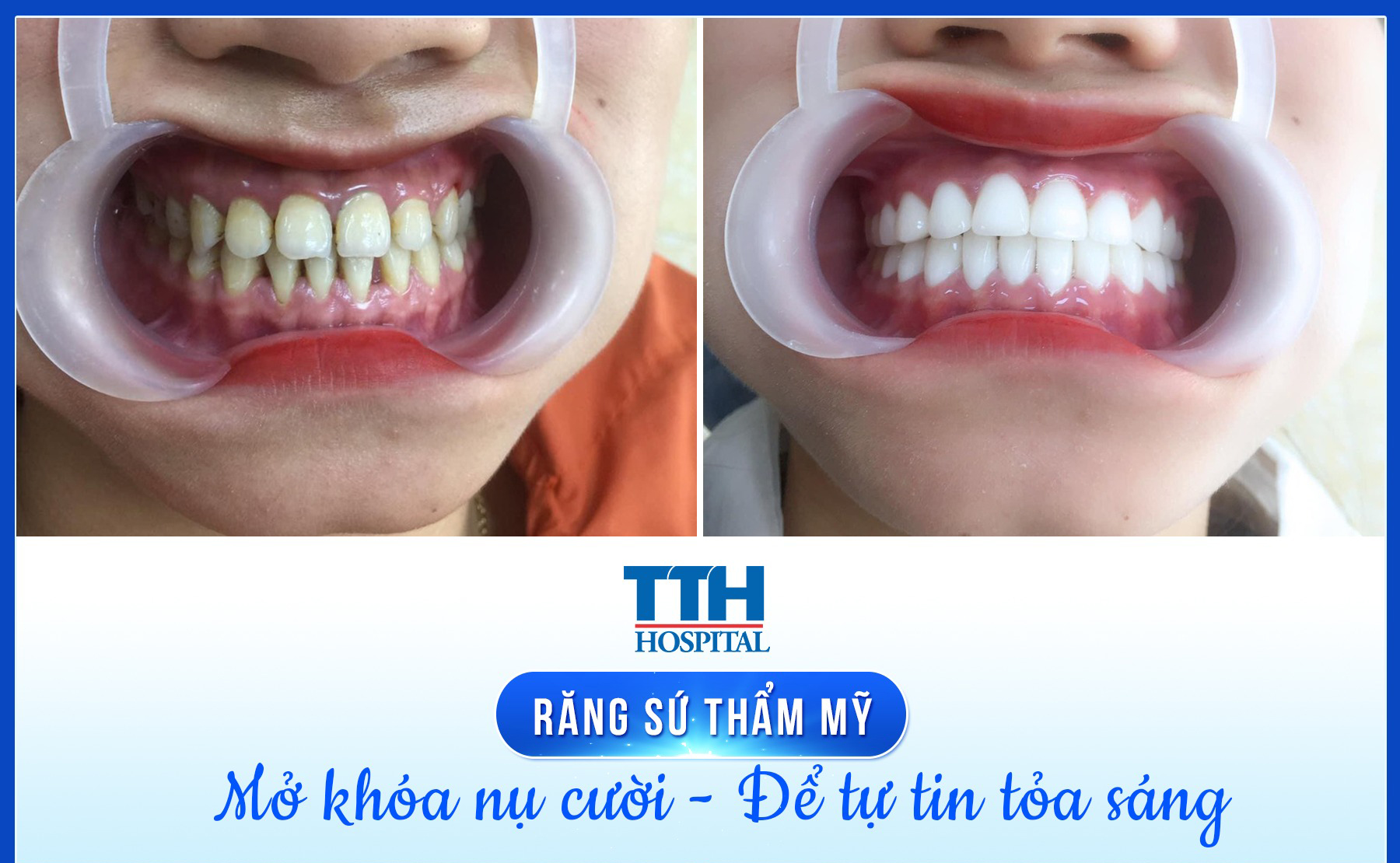 Bọc răng sứ có ăn uống bình thường được không