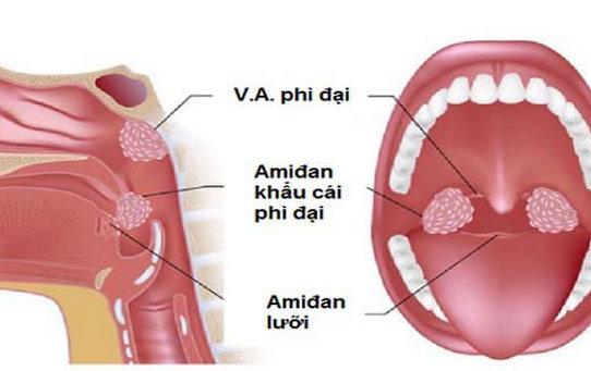 Nạo VA và những điều cần biết