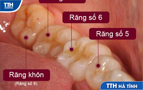 Nhổ răng số 8 ở đâu tại Hà Tĩnh