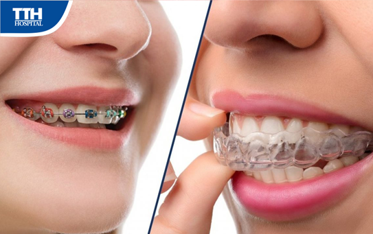 Tìm hiểu về phương pháp niềng răng trong suốt Invisalign