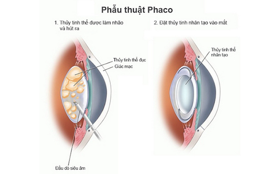 Ưu điểm khi mổ đục thủy tinh thể bằng phương pháp Phaco