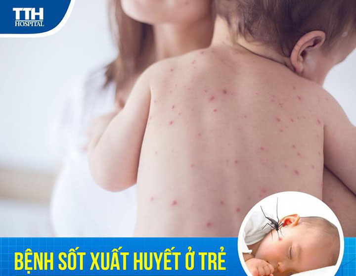 Bệnh sốt xuất huyết ở trẻ em: dấu hiệu và hướng điều trị