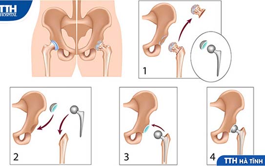 Thay khớp háng và những điều cần biết