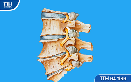 Phẫu thuật thoát vị đĩa đệm cột sống thắt lưng