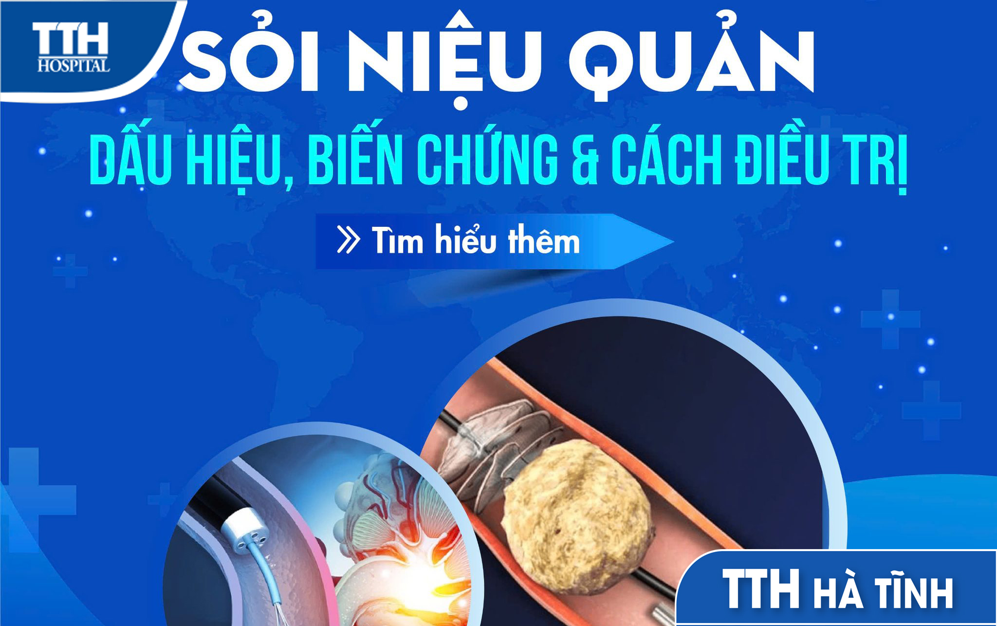 Sỏi niệu quản - dấu hiệu - biến chứng và cách điều trị