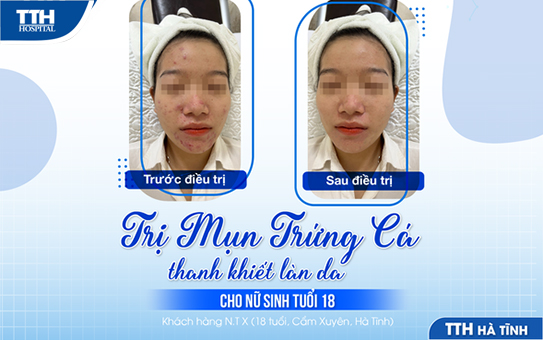 Trị mụn trứng cá thanh khiết làn da