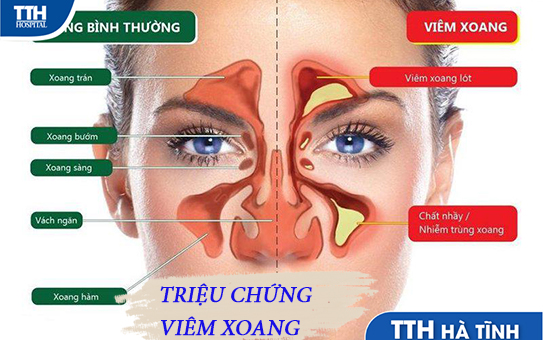 Triệu chứng viêm xoang