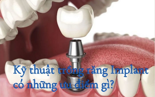 Kỹ thuật trồng răng implant có những ưu điểm gì?