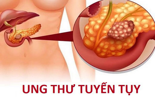 Tầm soát ung thư tuyến tụy