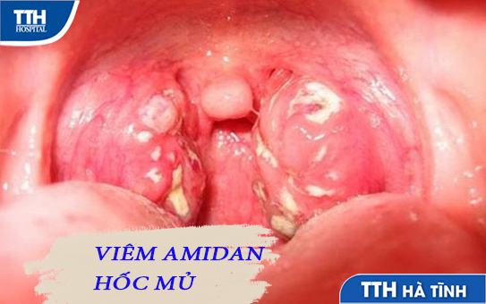 viêm amidan hốc mủ và những điều cần biết