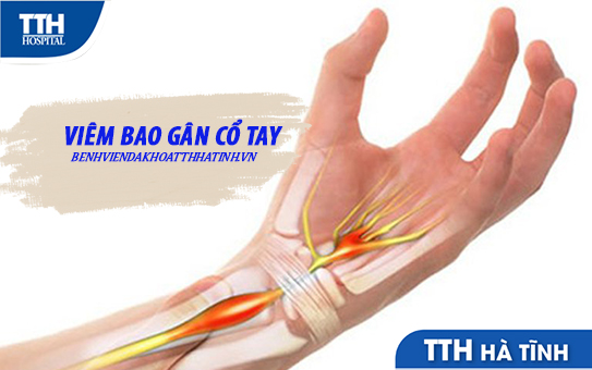 Viêm bao gân cổ tay và những điều cần biết