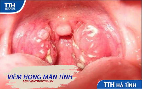 Tổng quan về bệnh viêm họng mãn tính