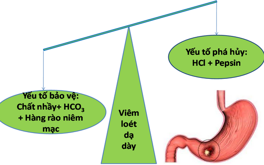 Tổng quan về bệnh viêm loét dạ dày tá tràng