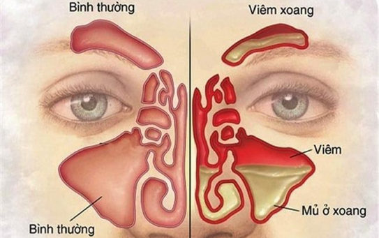 Cần lưu ý những gì khi sử dụng thuốc xịt mũi trị viêm xoang