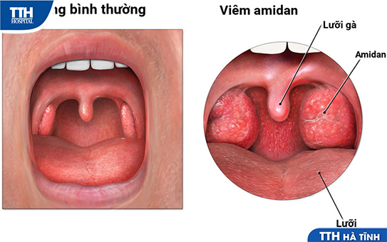 Amidan quá phát độ 3