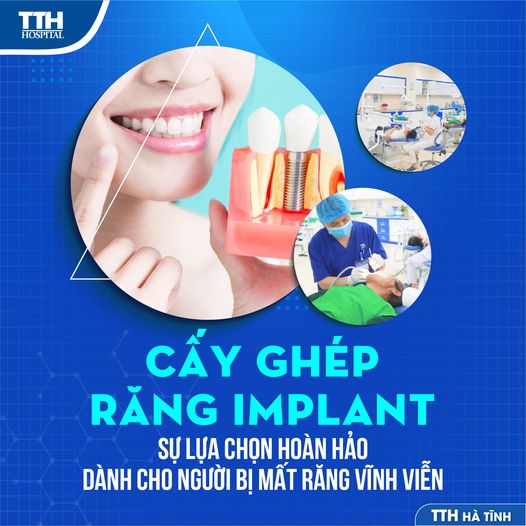 BẬT MÍ TOP 5 DÒNG TRỤ IMPLANT TỐT NHẤT HIỆN NAY