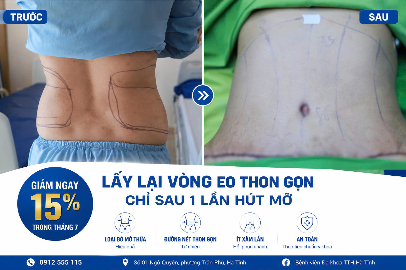 LẤY LẠI VÒNG EO THON GỌN – ỨNG DỤNG CÔNG NGHỆ HÚT MỠ BẰNG TIA NƯỚC BODY-JET TẠI TTH HÀ TĨNH
