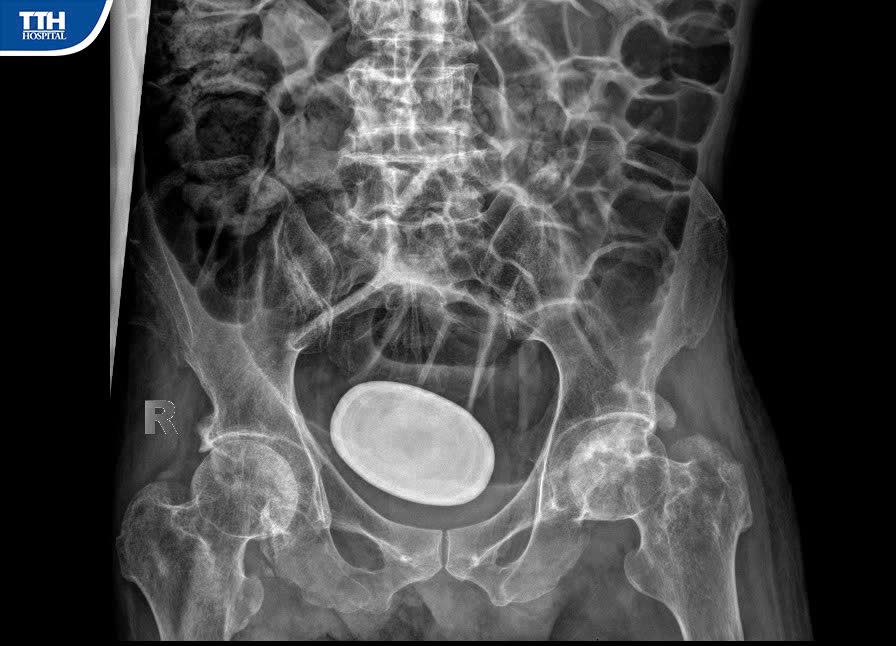 💥 VIÊN SỎI “KHỔNG LỒ” TRONG BÀNG QUANG BỆNH NHÂN LIỆT TỨ CHI - VÀ CÁI KẾT BẤT NGỜ! 💥