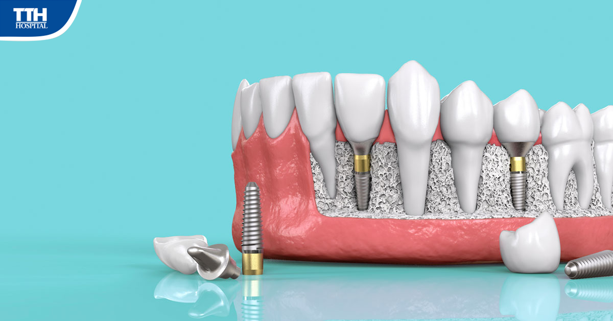 4 ĐIỀU CẦN BIẾT KHI TRỒNG RĂNG IMPLANT