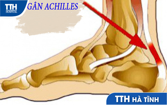 Viêm gân Achilles