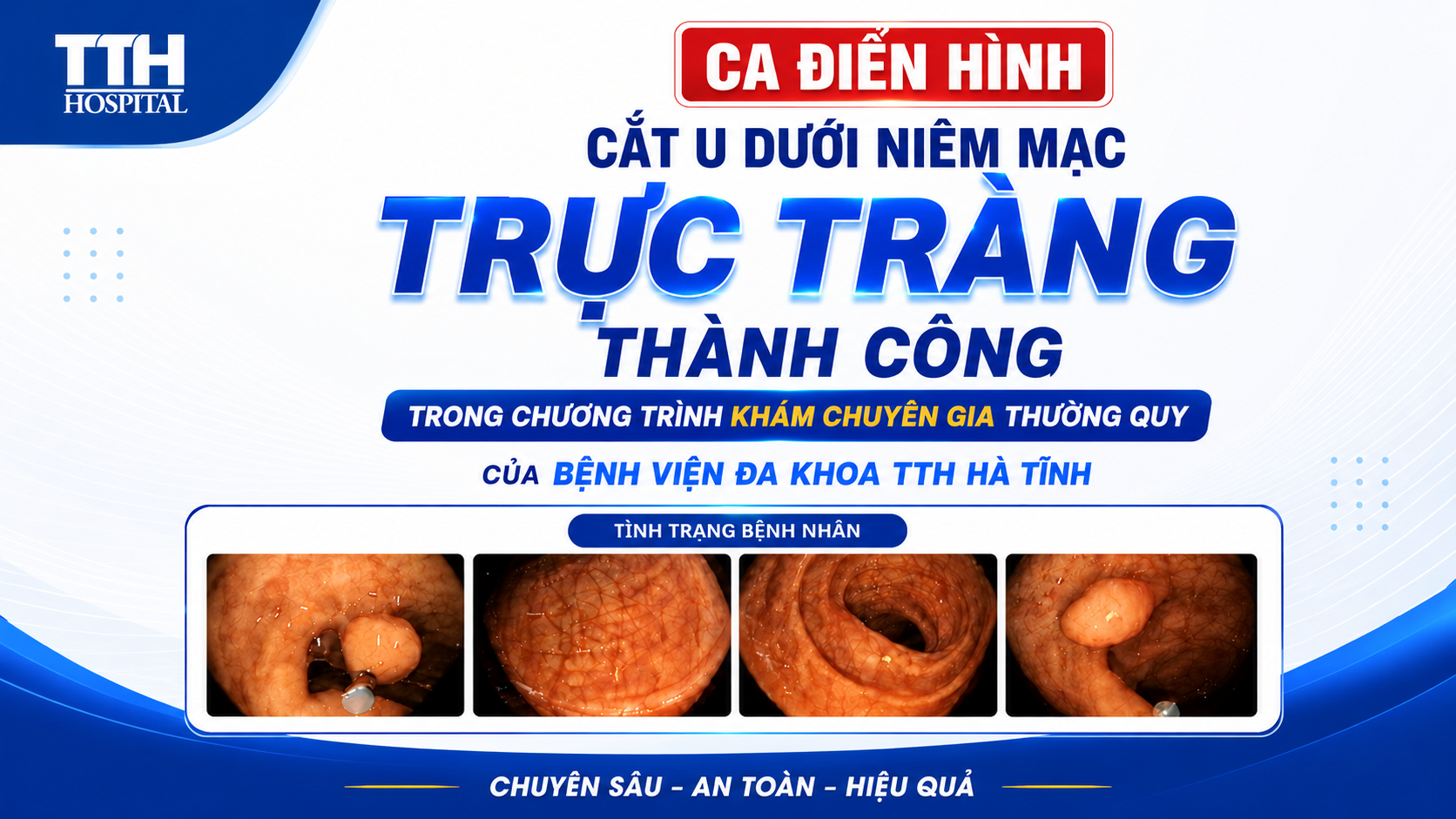 [CA ĐIỂN HÌNH] CẮT U DƯỚI NIÊM MẠC TRỰC TRÀNG THÀNH CÔNG TẠI HÀ TĨNH CÙNG CHUYÊN GIA BỆNH VIỆN K