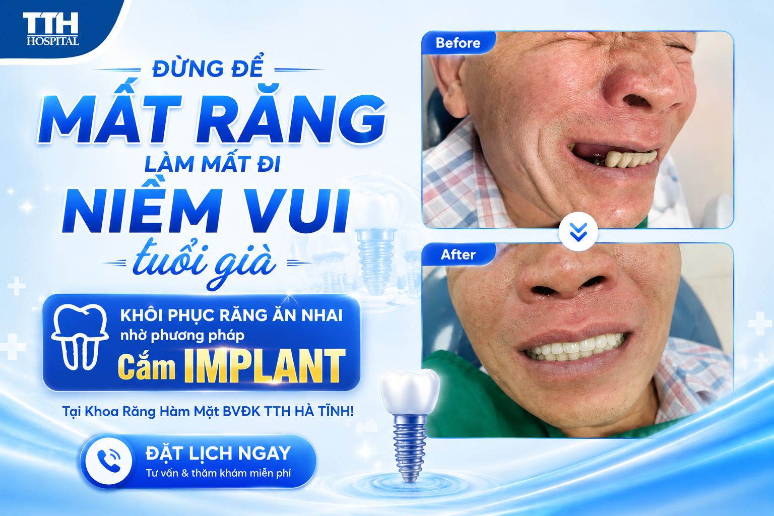 MẤT RĂNG TUỔI GIÀ: KHÔI PHỤC 95% KHẢ NĂNG ĂN NHAI NHỜ CẮM IMPLANT TẠI TTH HÀ TĨNH
