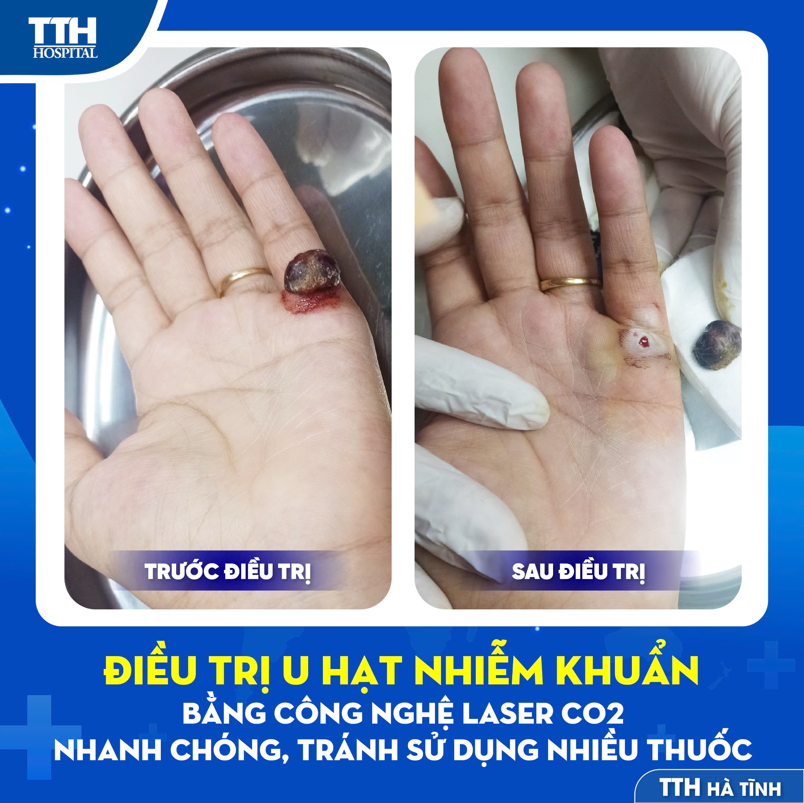 ĐIỀU TRỊ U HẠT NHIỄM KHUẨN BẰNG CÔNG NGHỆ LASER CO2 - NHANH CHÓNG, TRÁNH SỬ DỤNG NHIỀU THUỐC