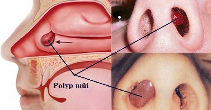 Polyp mũi xoang là bệnh gì?